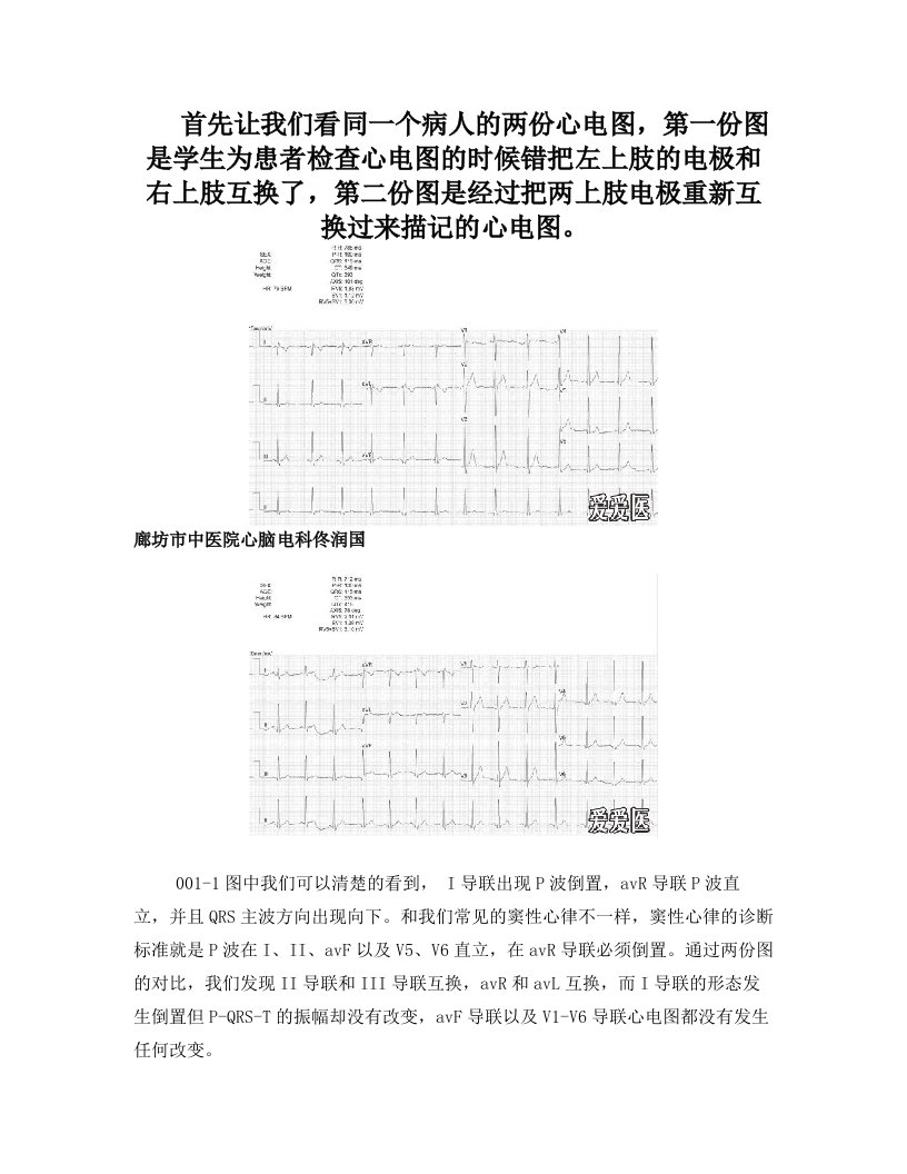 导联反接与右位心