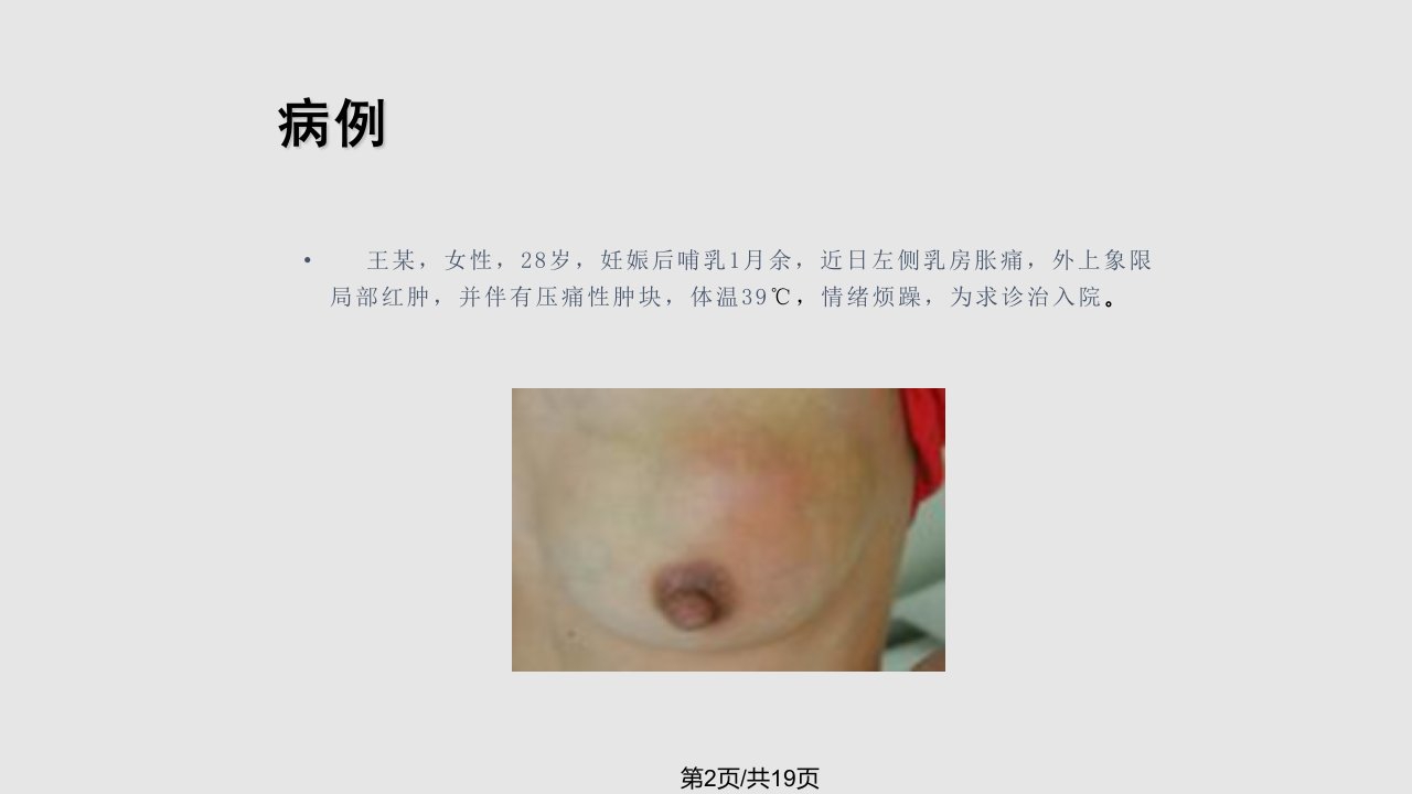 急性乳腺炎学习