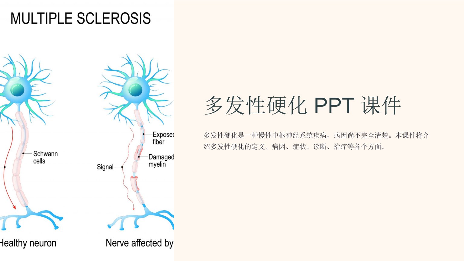 《多发性硬化》课件