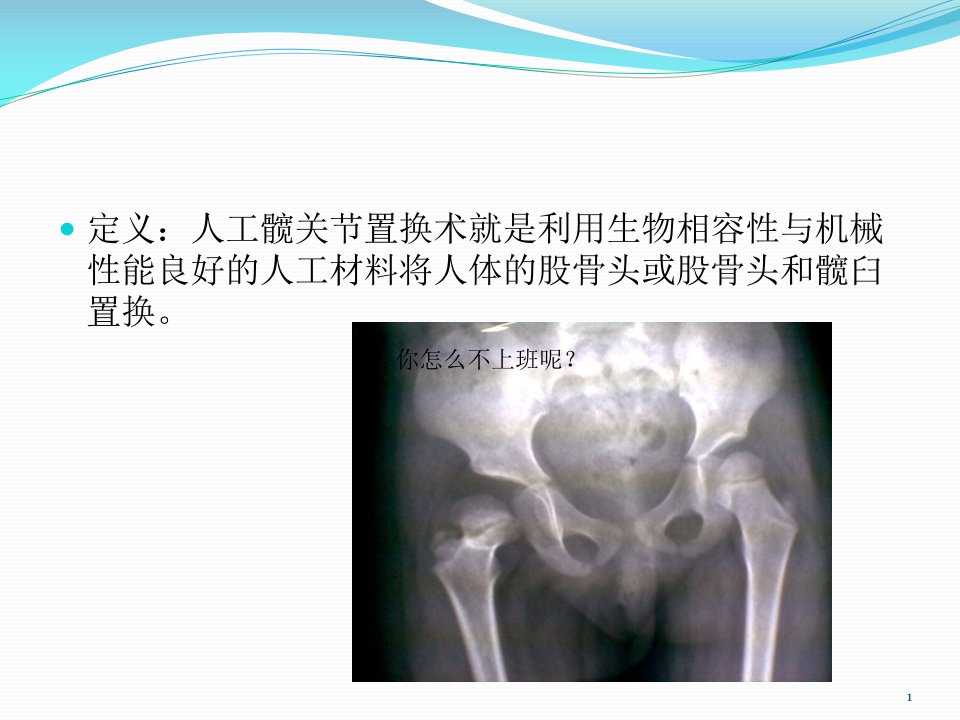 人工髋关节置换的术后护理PPT课件