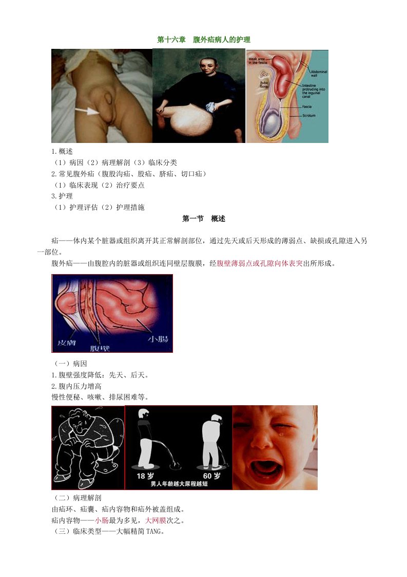 主管护师外科讲义：第十六章-腹外疝病人的护理