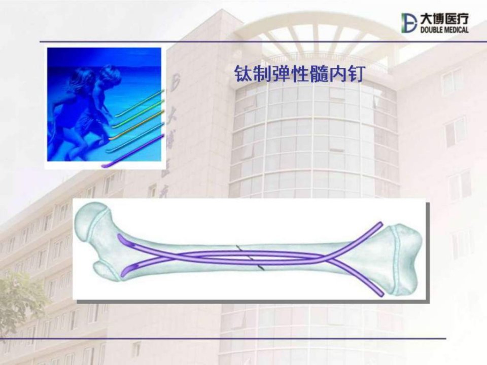 弹性髓内钉治疗儿童骨折操作技巧