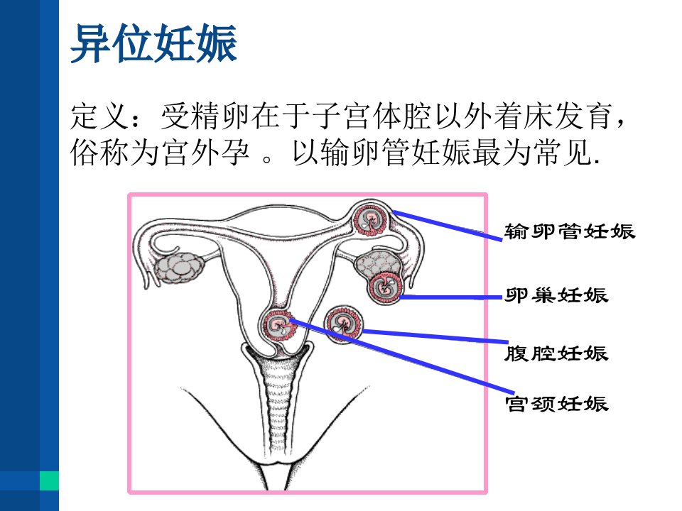 最新异位妊娠.小讲课pptPPT课件