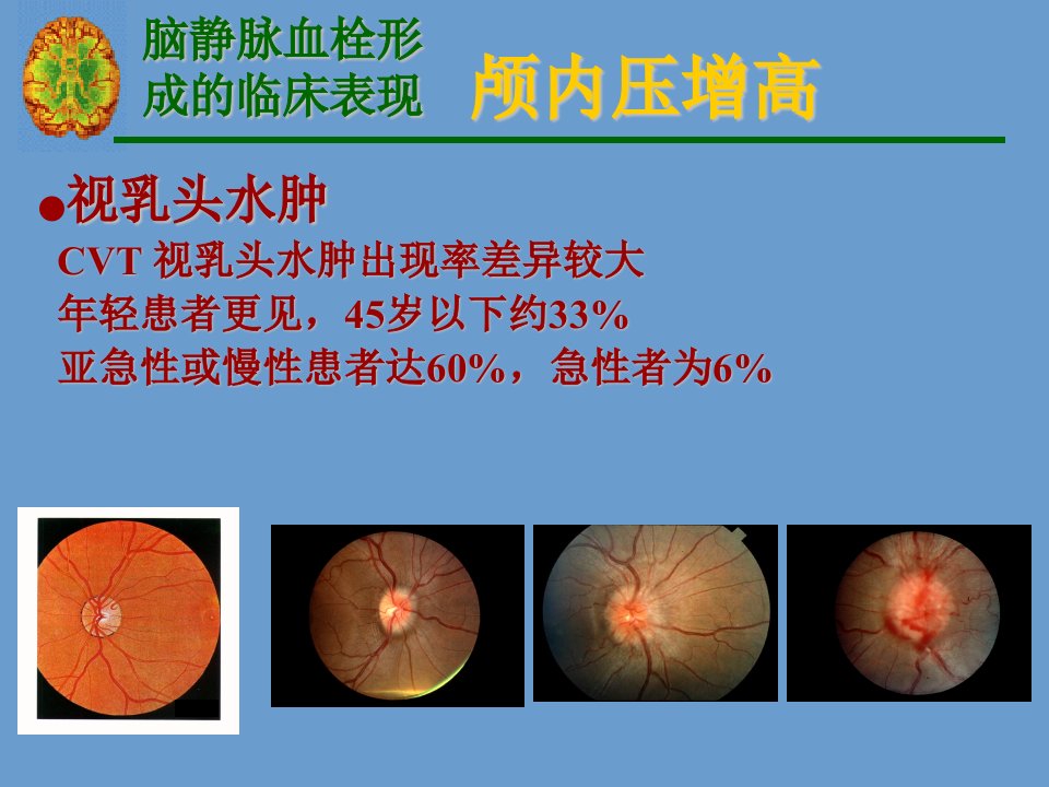 《脑静脉血栓形》PPT课件