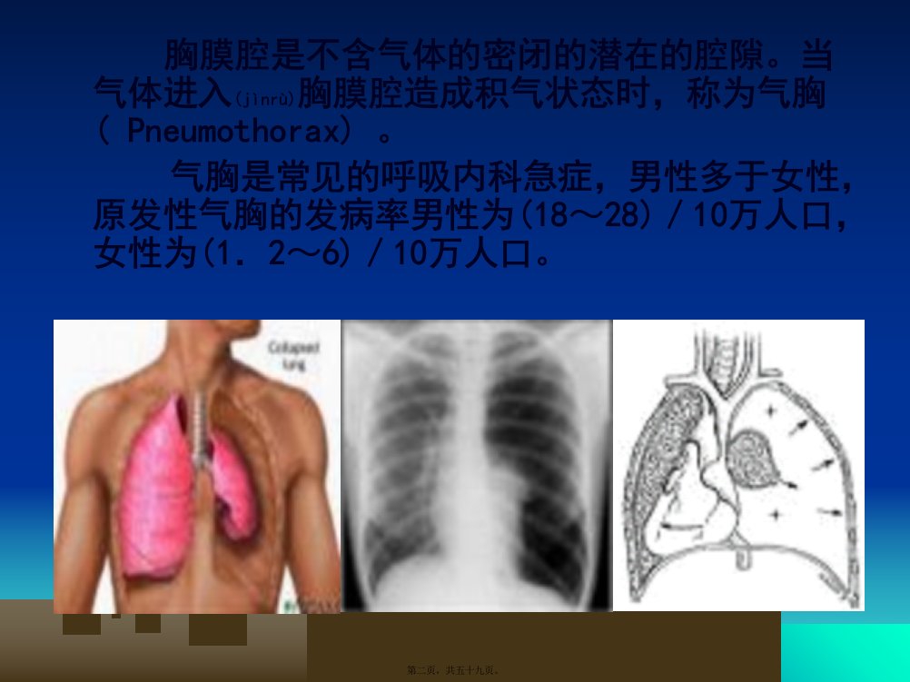 自发性气胸