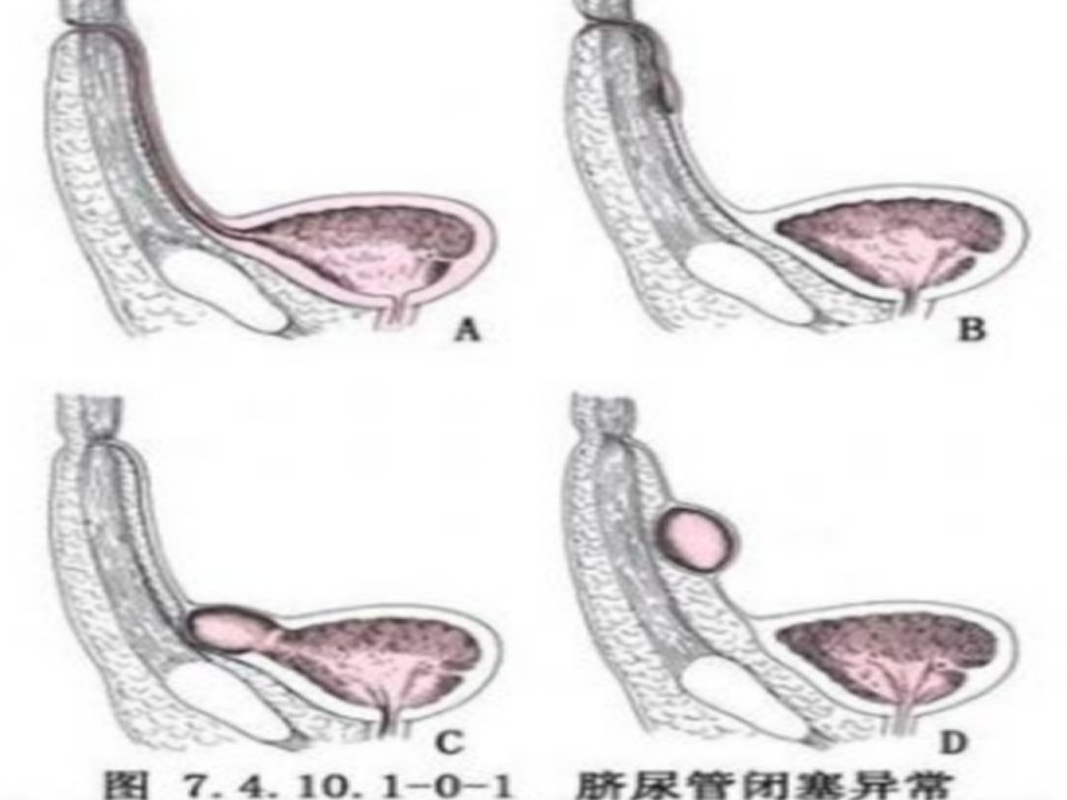 脐茸+脐尿管囊肿幻灯片