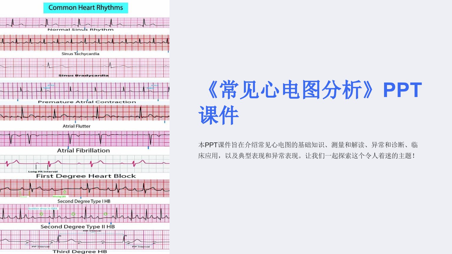 《常见心电图分析》课件