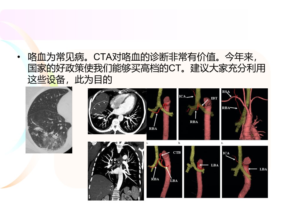 咯血的多层螺旋CT血管成像