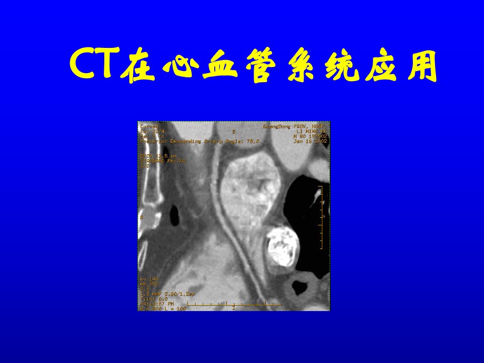 临床医学]多排螺旋CT心血管成像