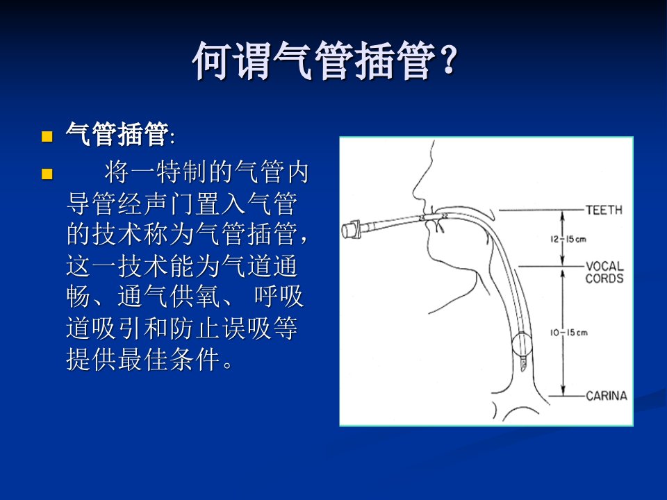 气管插管护理配合