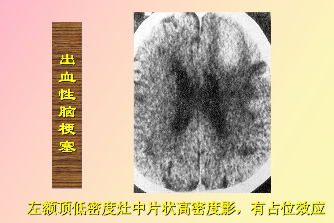 急性脑血管病的影像诊断