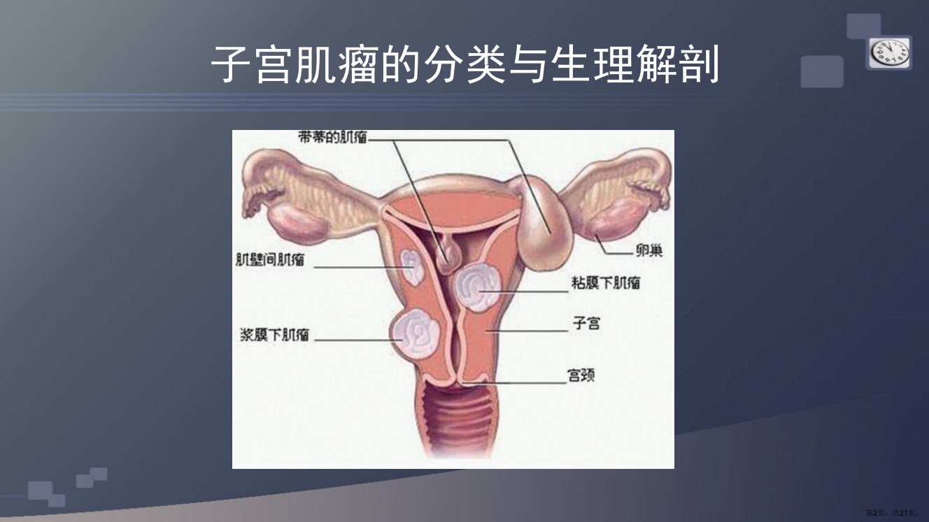 子宫肌瘤的护理查房课件PPT21页