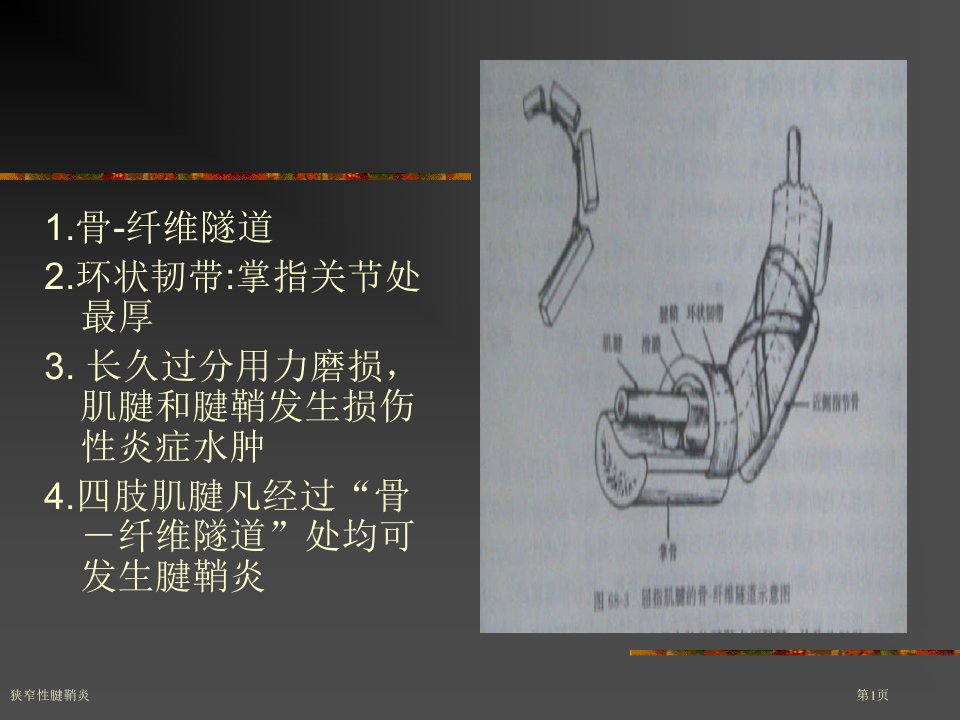 狭窄性腱鞘炎课件PPT