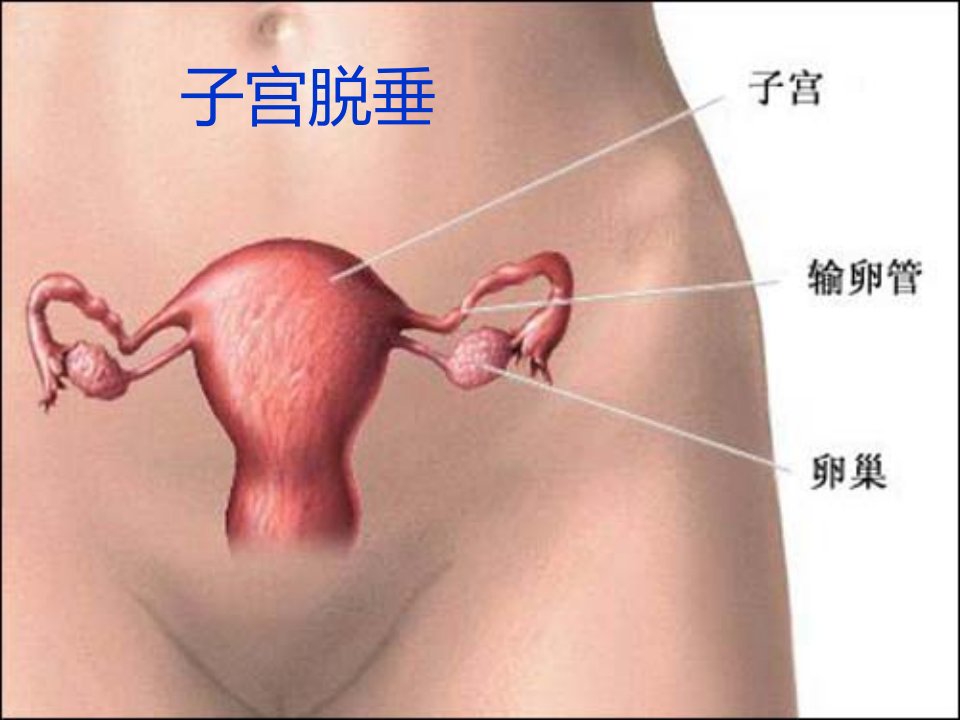 子宫脱垂病人的护理