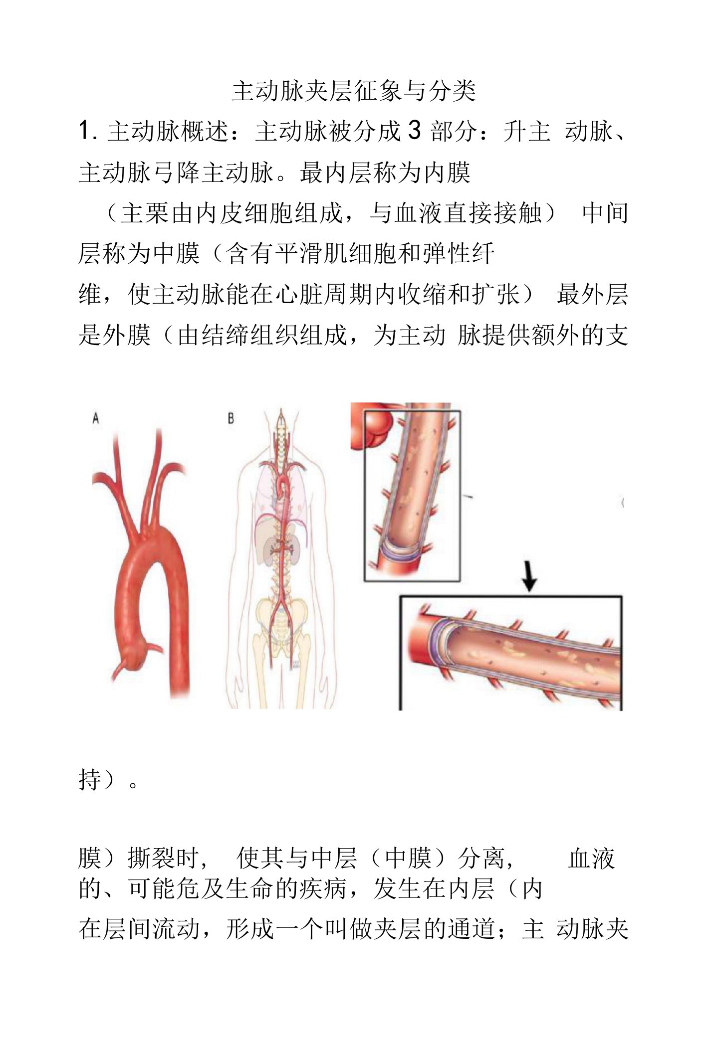 主动脉夹层的影像诊断