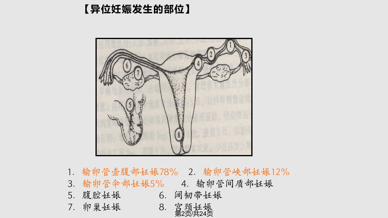 异位妊娠的护理1