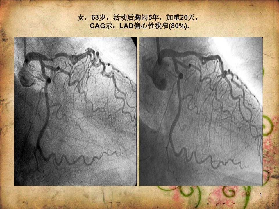 中医药防治冠心病培训ppt课件