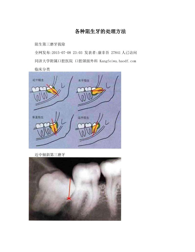 各种阻生牙的处理方法