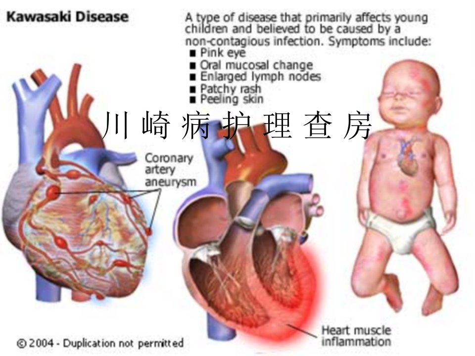 川崎病的护理查房医学ppt课件