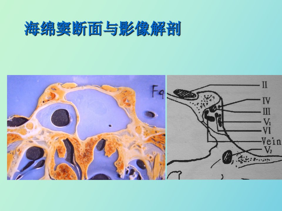 海绵窦断面与影像解剖PPT课件