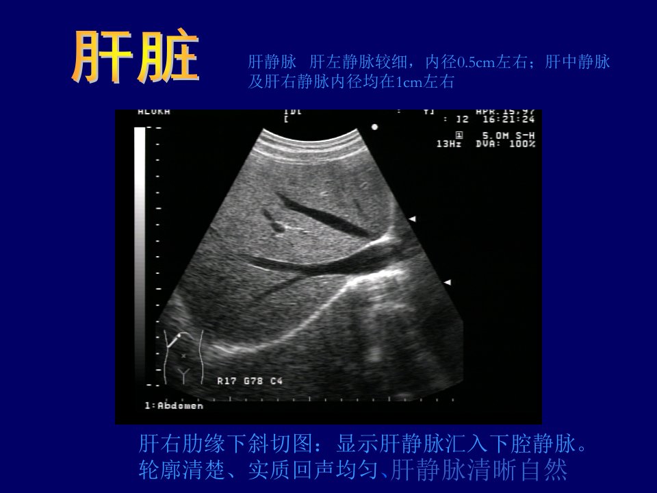 B超影像图谱PPT课件