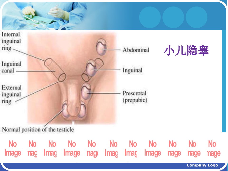 小儿隐睾