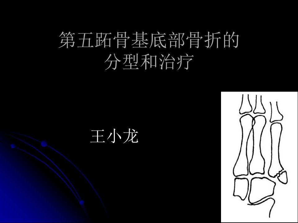 第五跖骨基底部骨折的分型与治疗