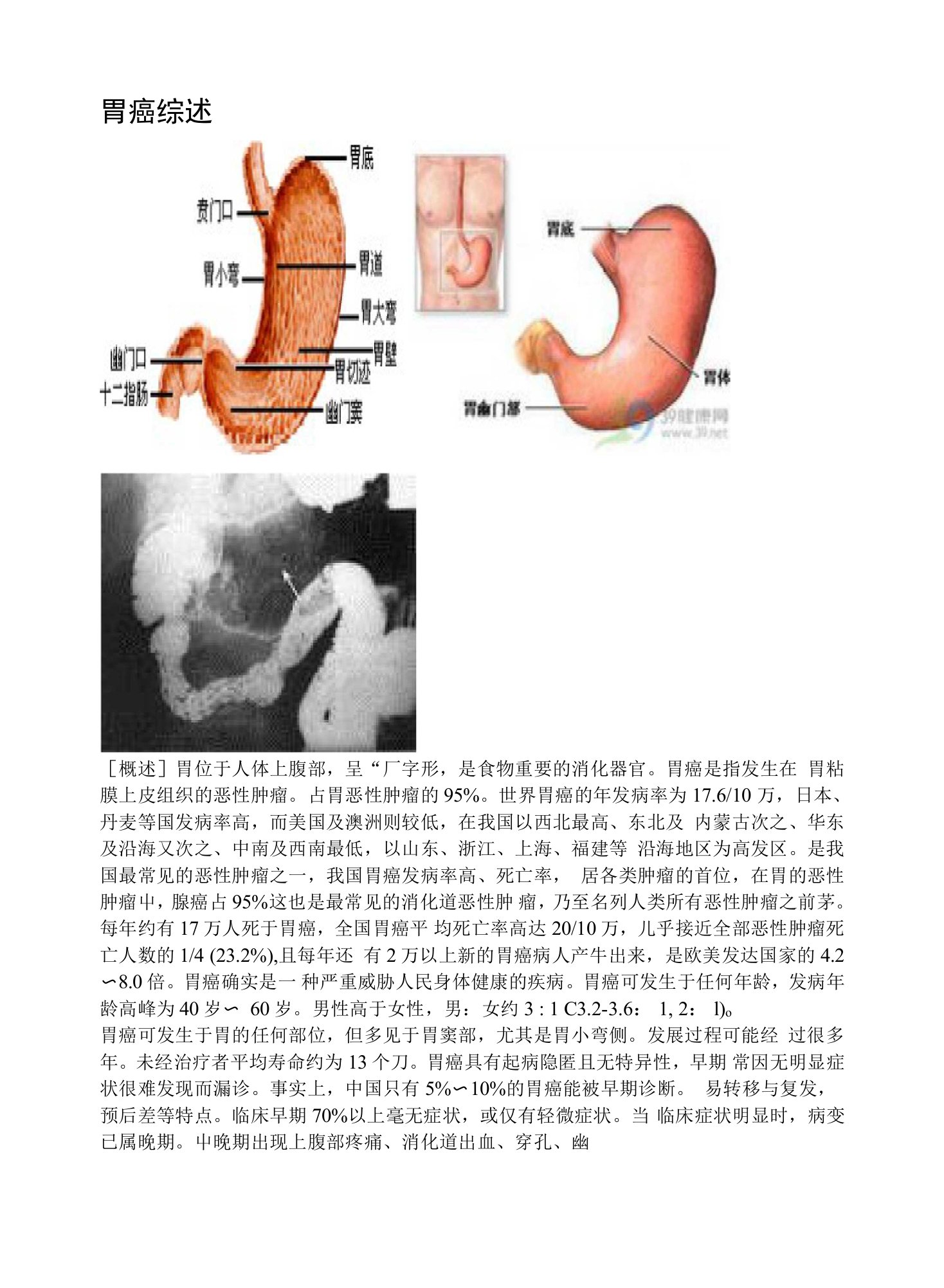 [临床医学]胃癌综述