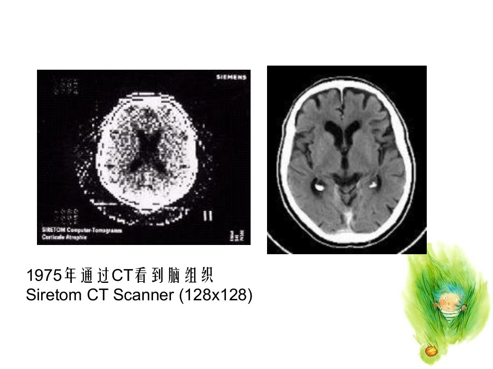 CT临床应用脑教案