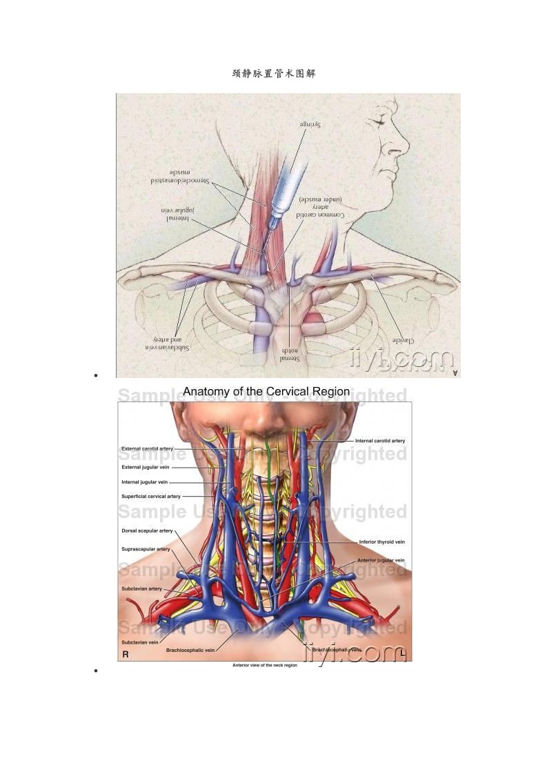 颈内静脉置管术现用图解