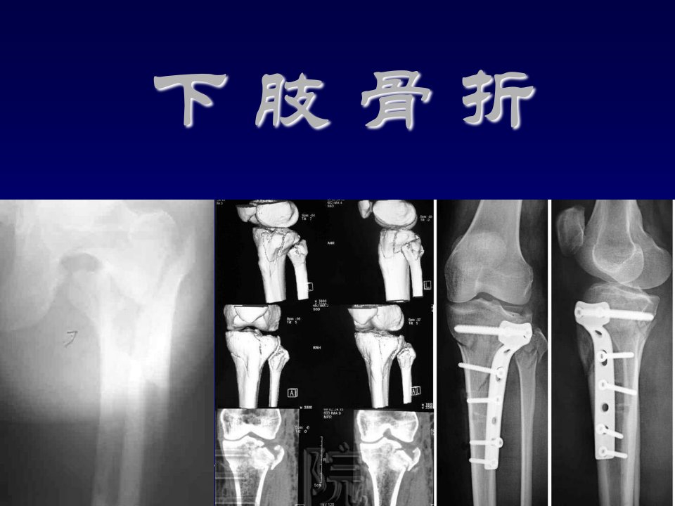 中医骨伤科学下肢骨折