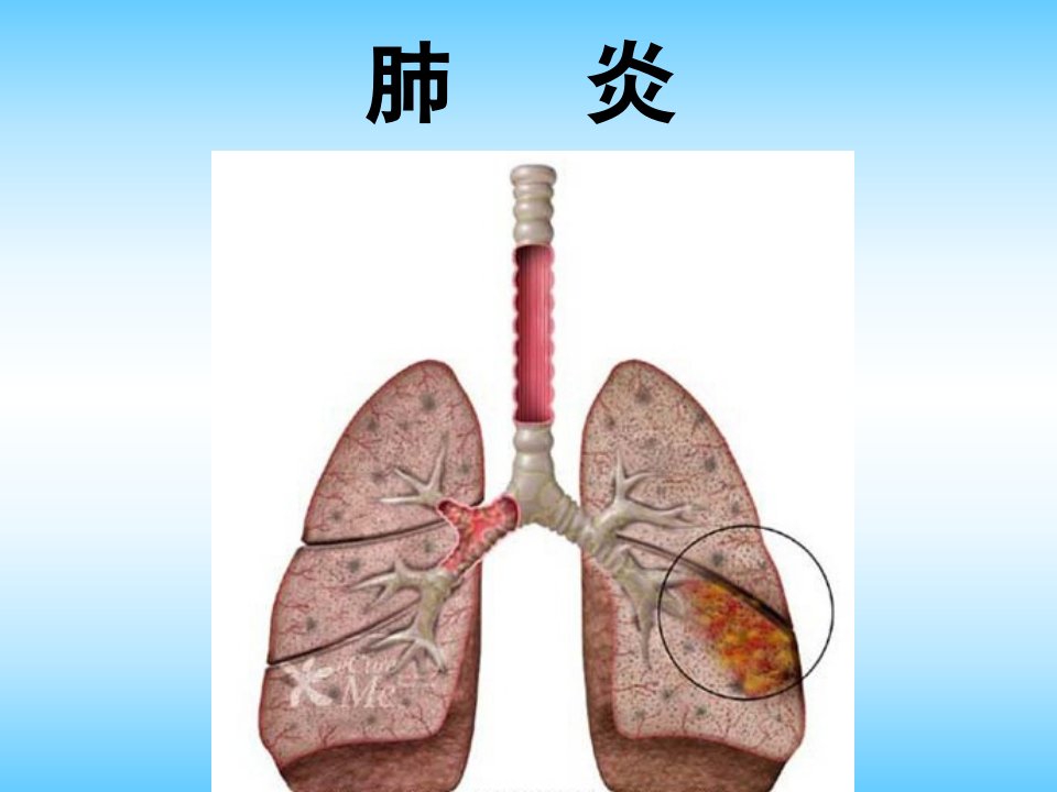 《肺炎护理》PPT课件