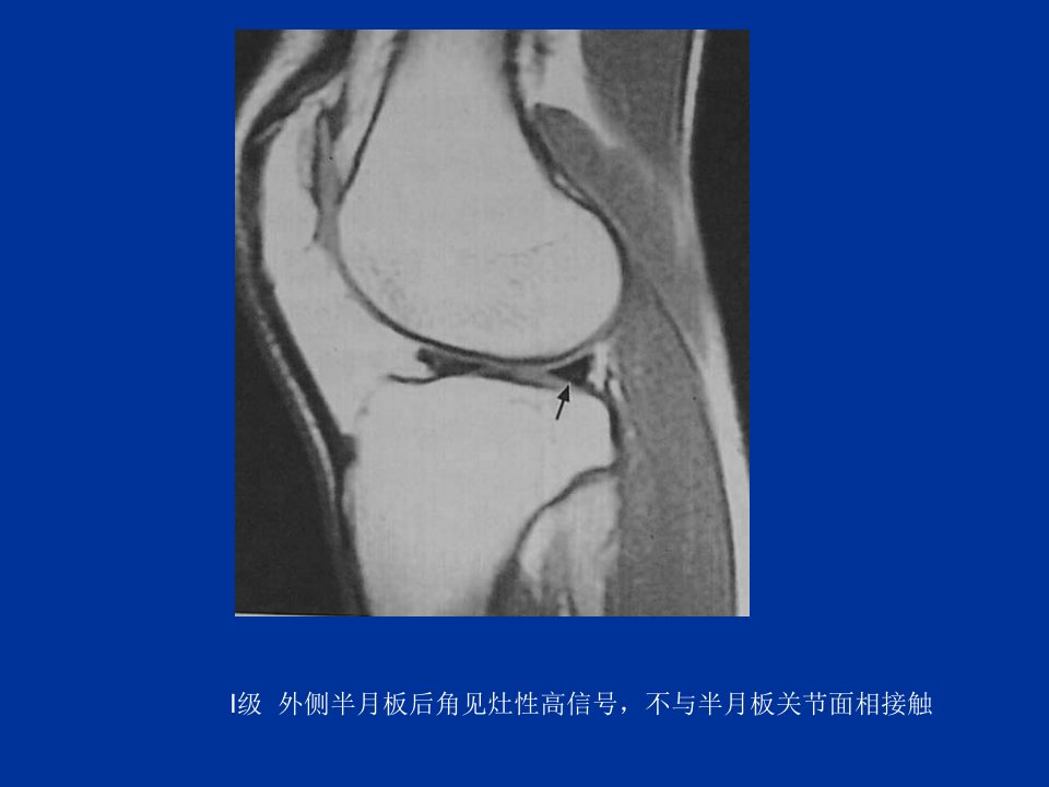 最新0053膝关节半月板病变MRI病例图及分析-PPT文档