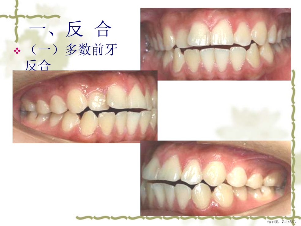 第九章常见错合畸形的矫治