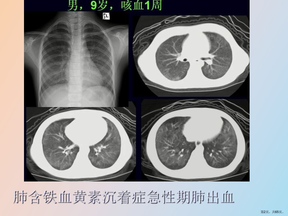 教学课件胸部少见疾病影像诊断