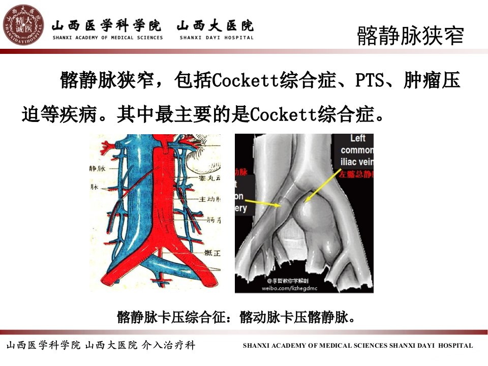 髂静脉支架的选择和支架定位ppt课件