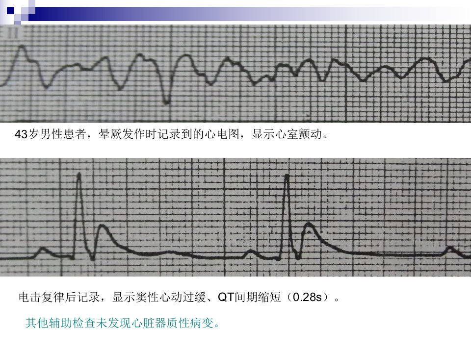 《短QT综合征》PPT课件