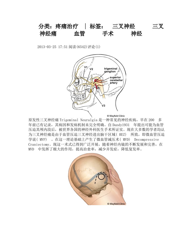 三叉神经手术解剖