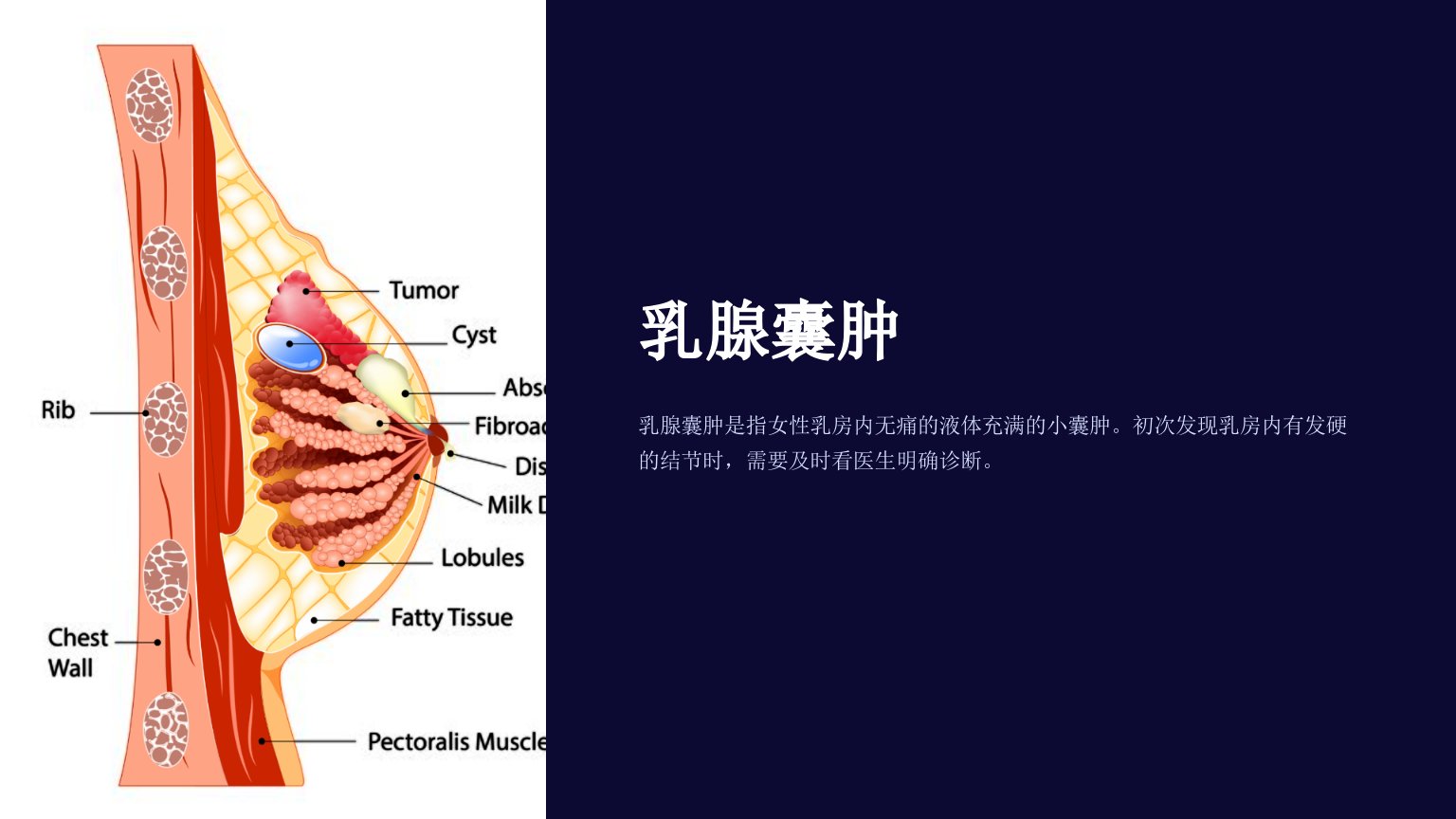 《乳腺囊肿》课件