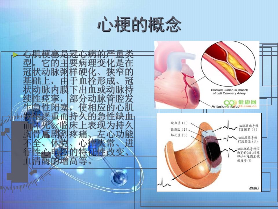 急性心肌梗塞的护理课件