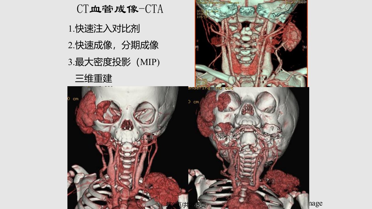 CTMR在儿科的应用孙国强