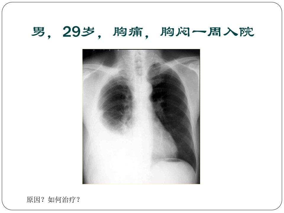 胸腔积液课件