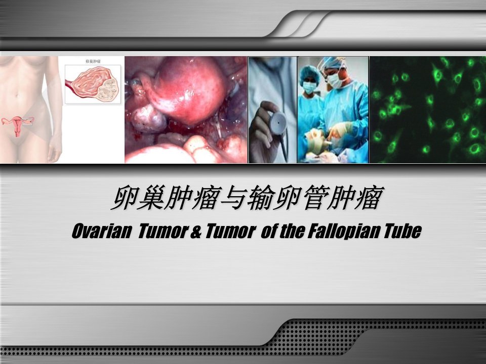 卵巢肿瘤与输卵管肿瘤ppt课件
