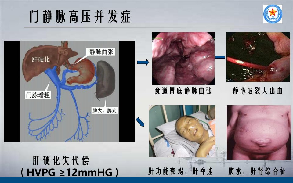 知识学习TIPS治疗肝硬化门脉高压