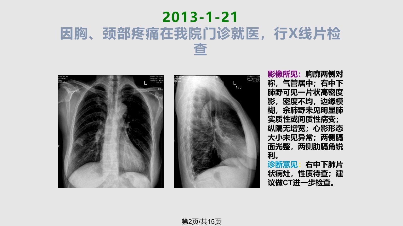 空洞型肺结核病例讨论