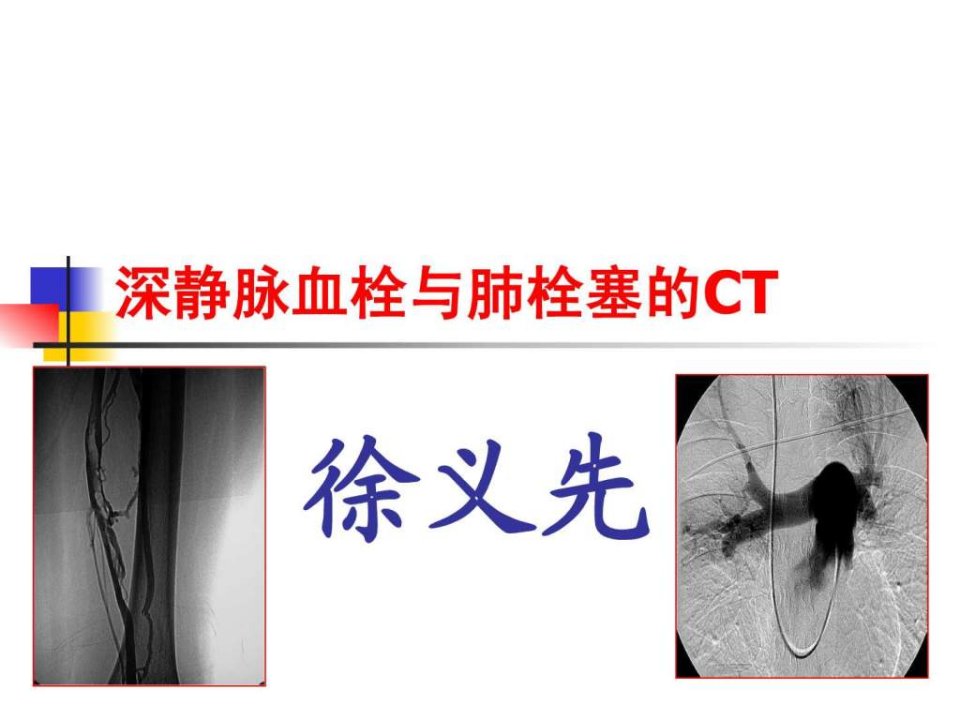 肺栓塞的CT.ppt