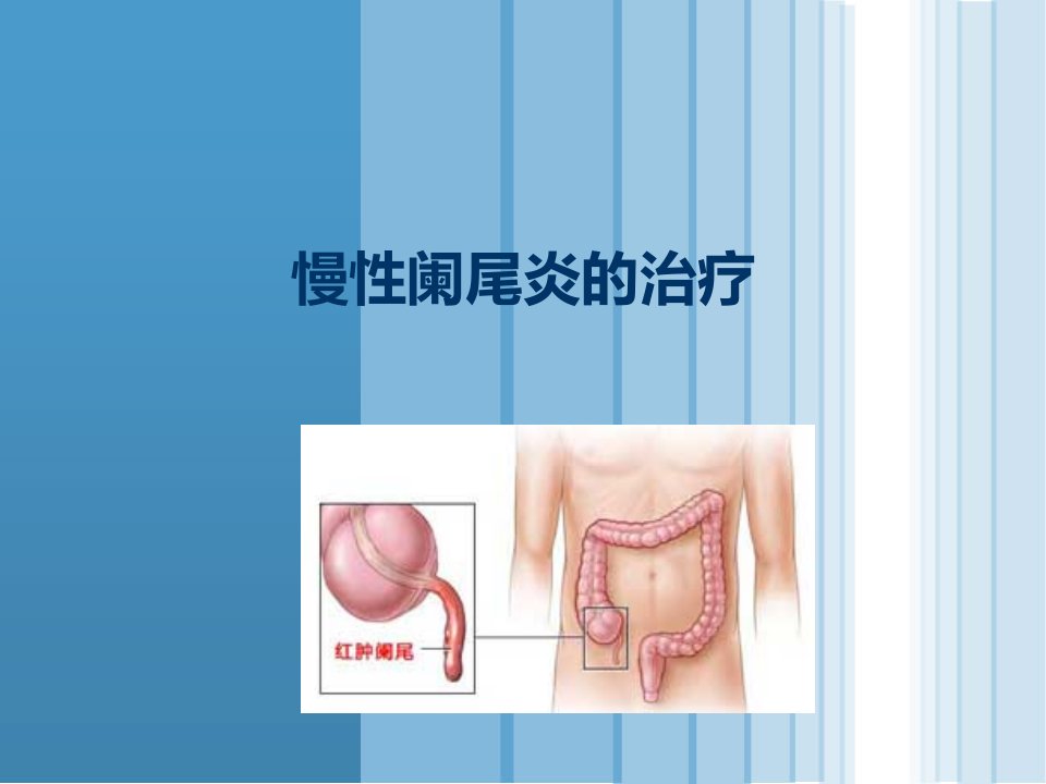 慢性阑尾炎的治疗