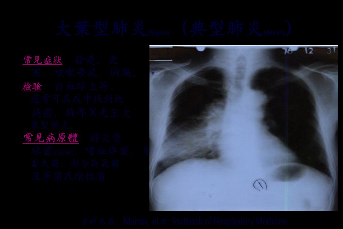 医学专题严重急性呼吸道症候群