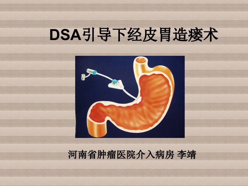 dsa引导下经皮胃造瘘术--李靖