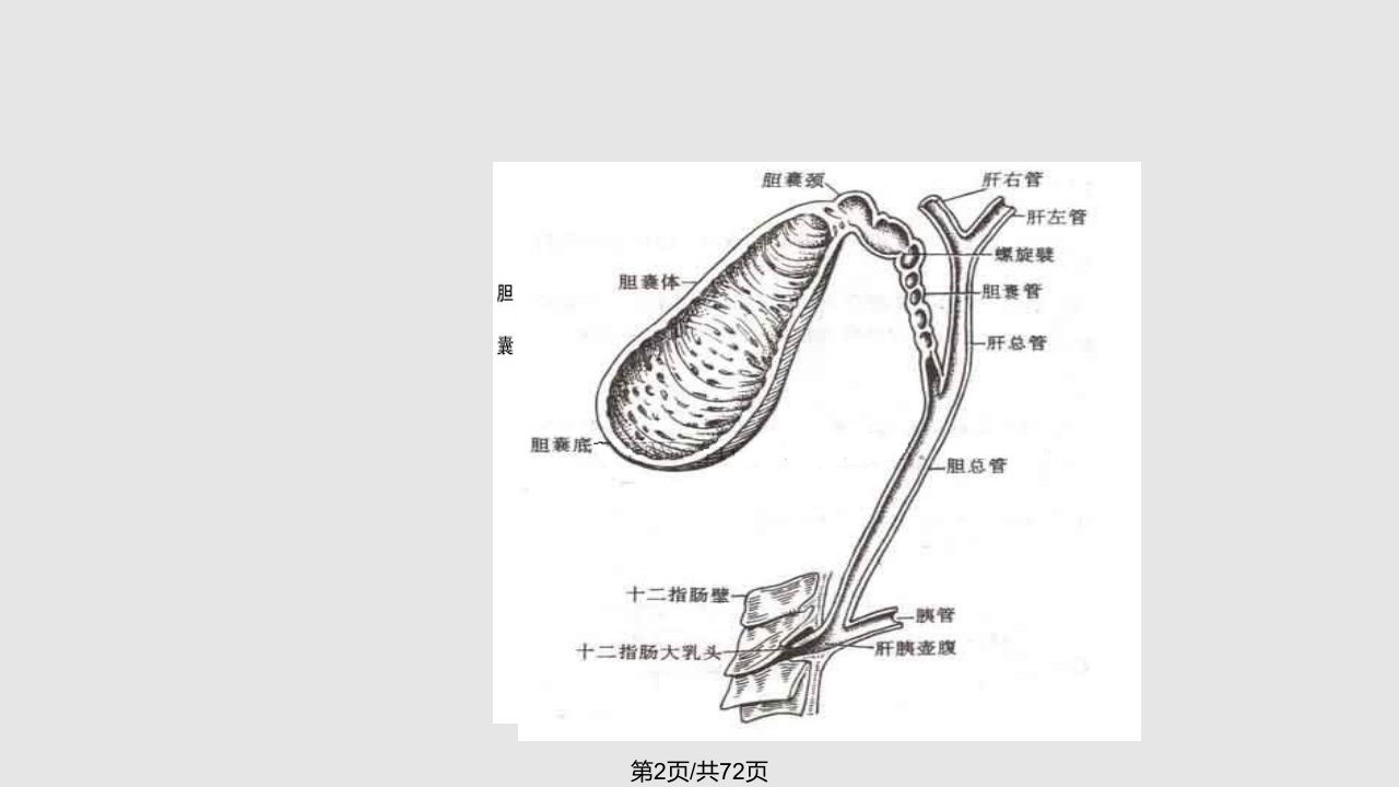 胆总管结石的护理查房